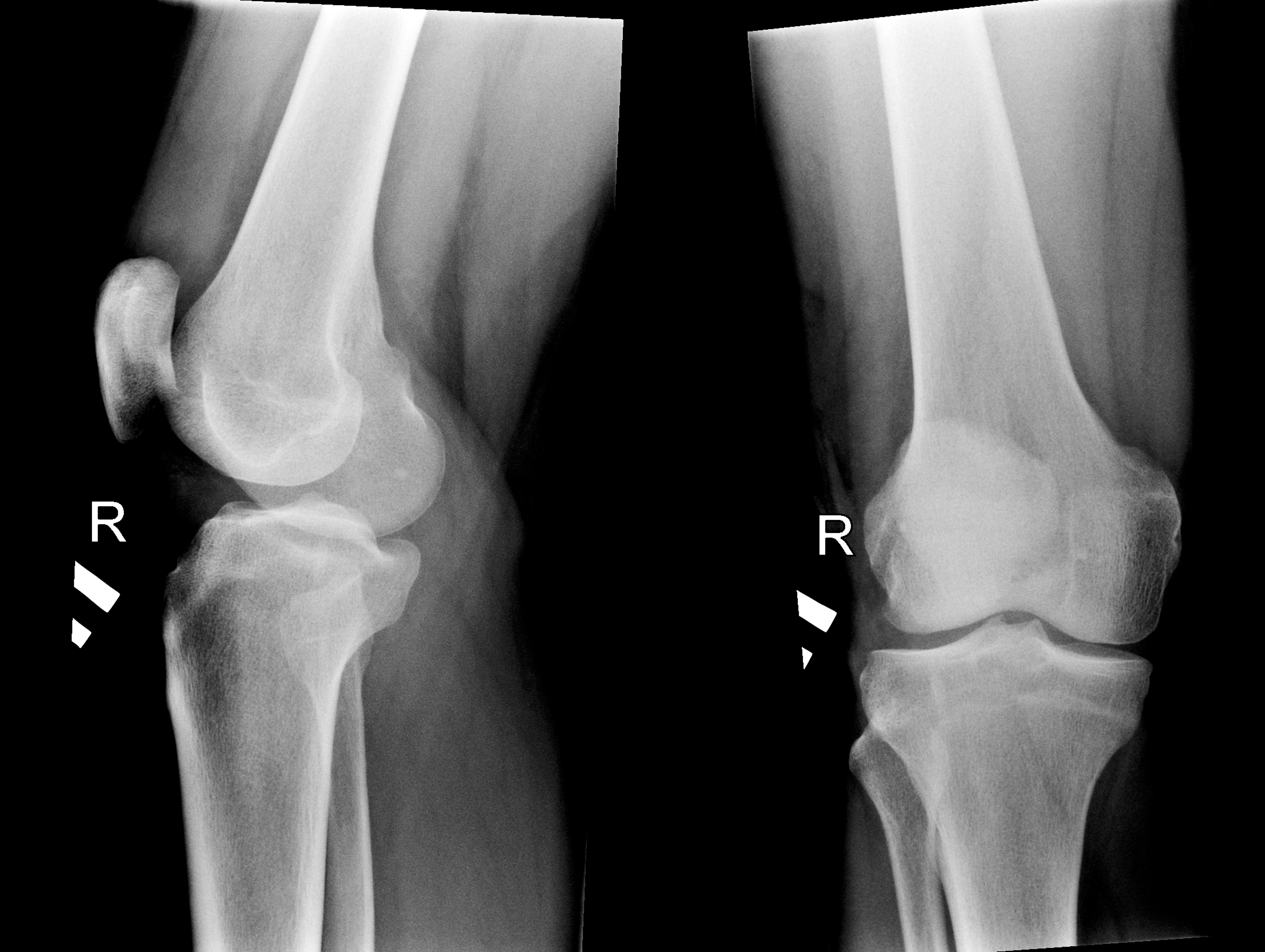 acl-anterior-cruciate-ligament-active-sports-medicine